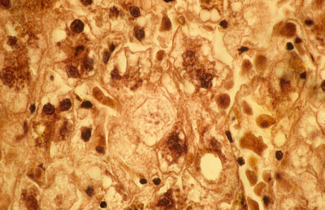 Viral hepatitis,light micrograph
