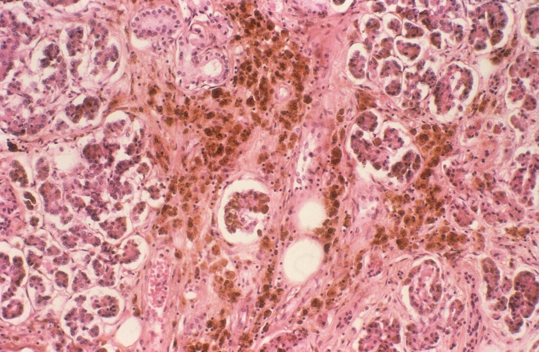 Haemochromatosis of the pancreas