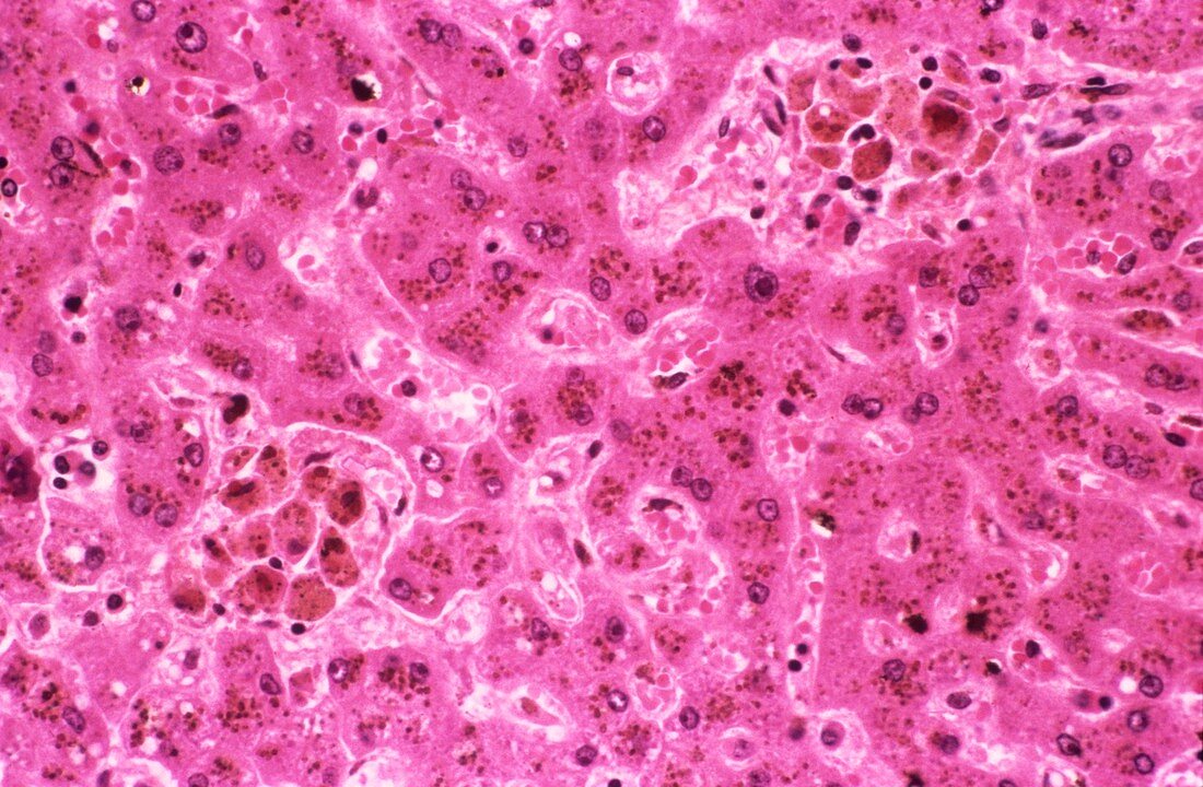 Siderosis in the liver,light micrograph
