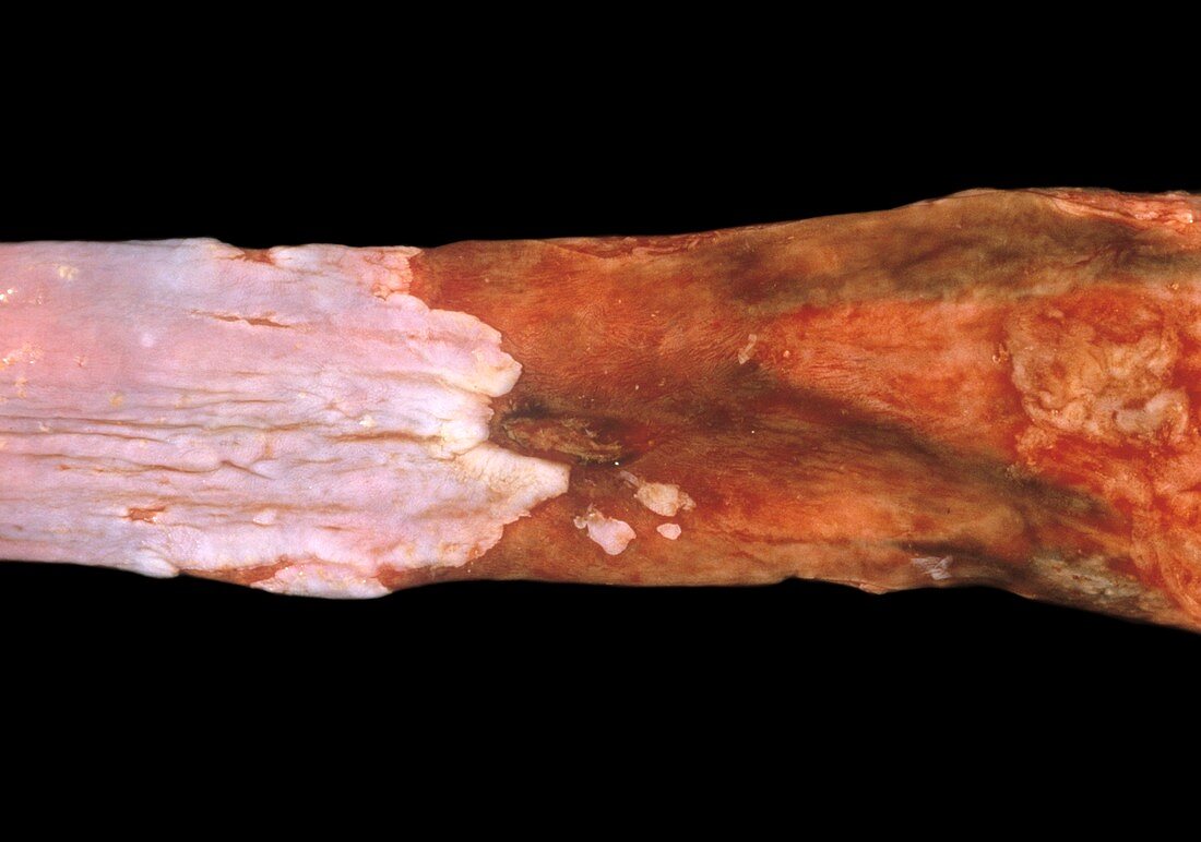 Inflamed oesophagus