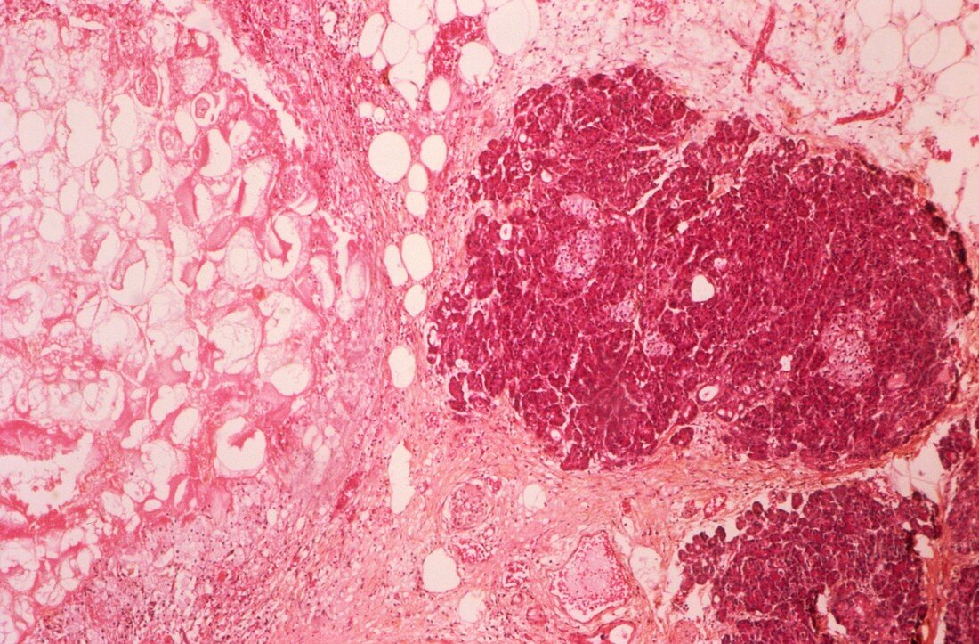 Acute haemorrhagic pancreatic necrosis