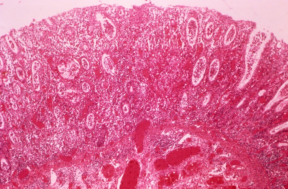 Ulcerative colitis,light micrograph