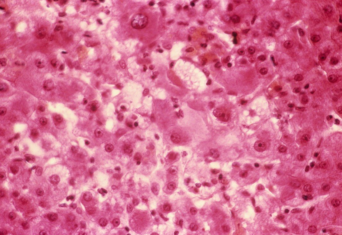Viral hepatitis,light micrograph