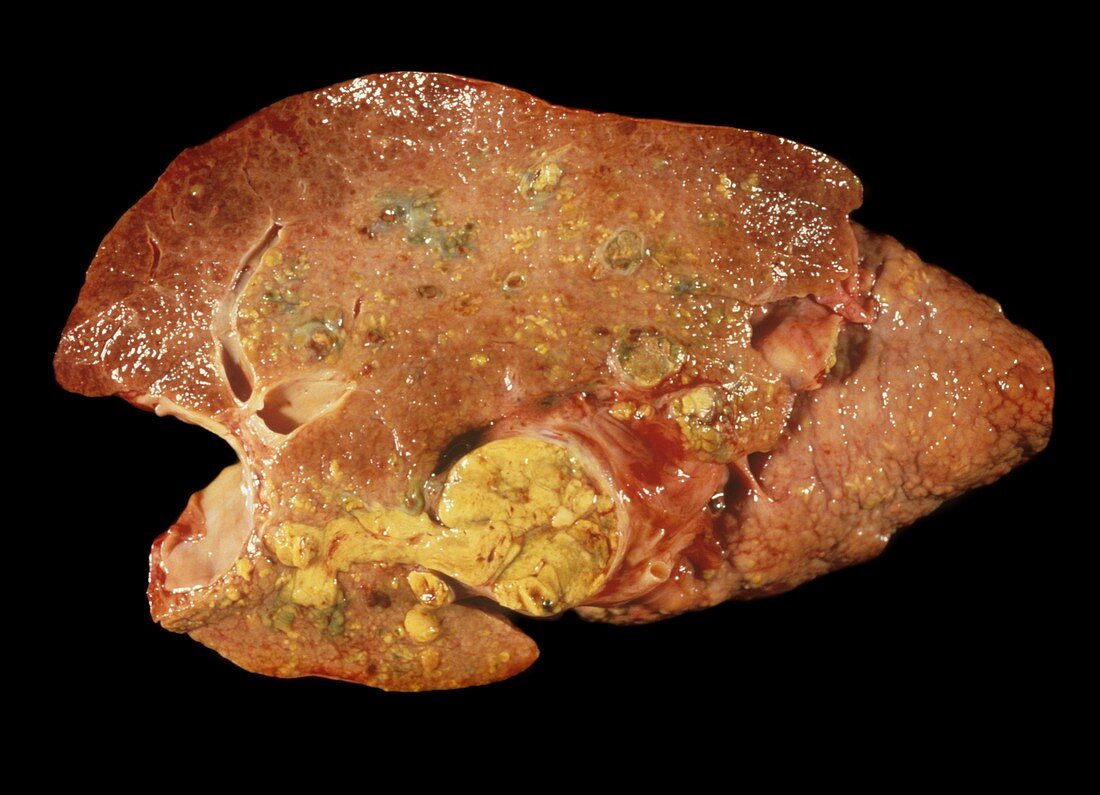 Liver cancer