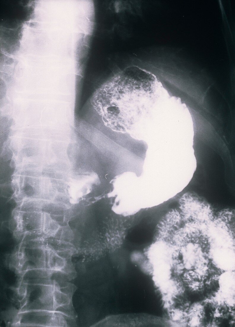 Intestinal cancer,X-ray
