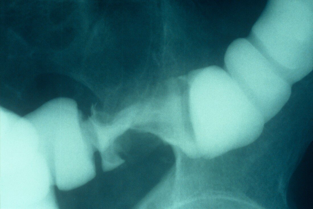 Narrowed colon,X-ray