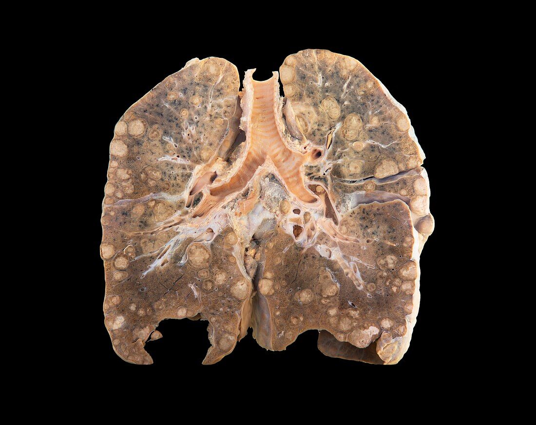 Secondary lung cancer,clinical specimen