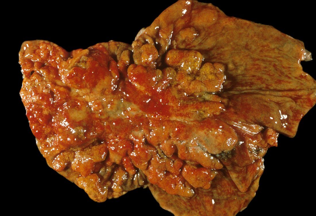 Secondary cancer of the stomach