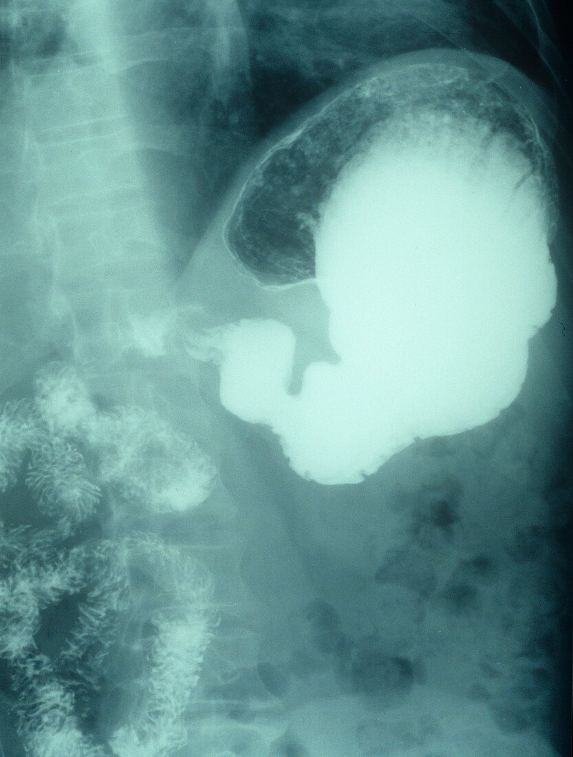 Obstructed small intestine,X-ray