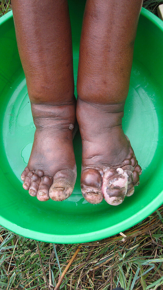 Feet in podoconiosis