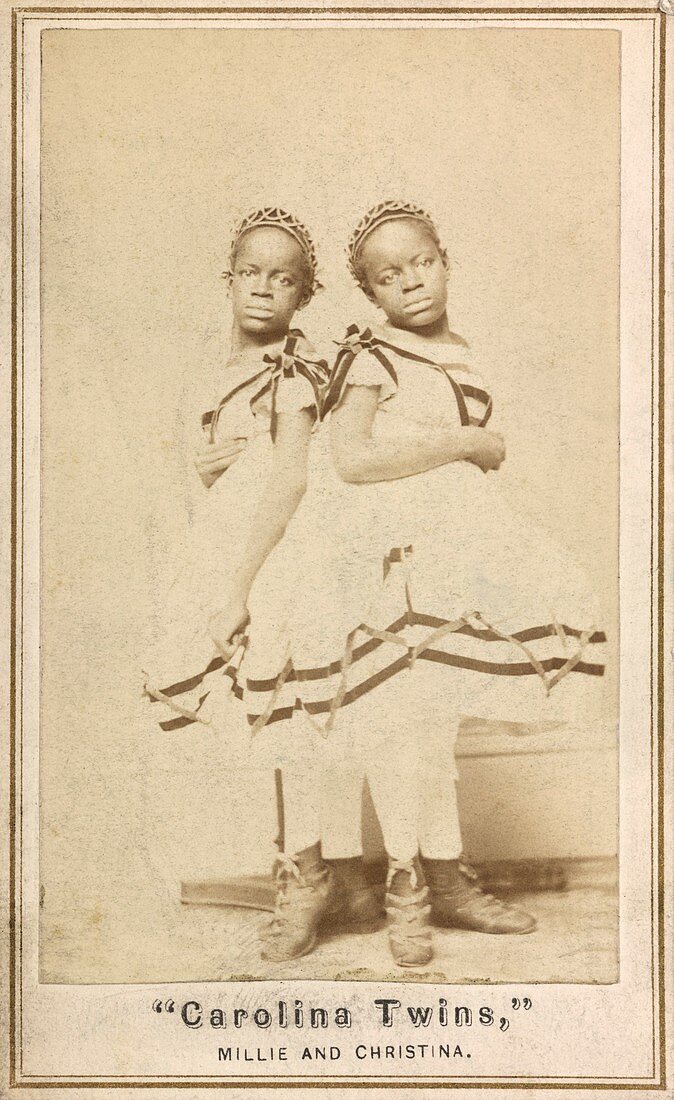 Conjoined twins,19th century