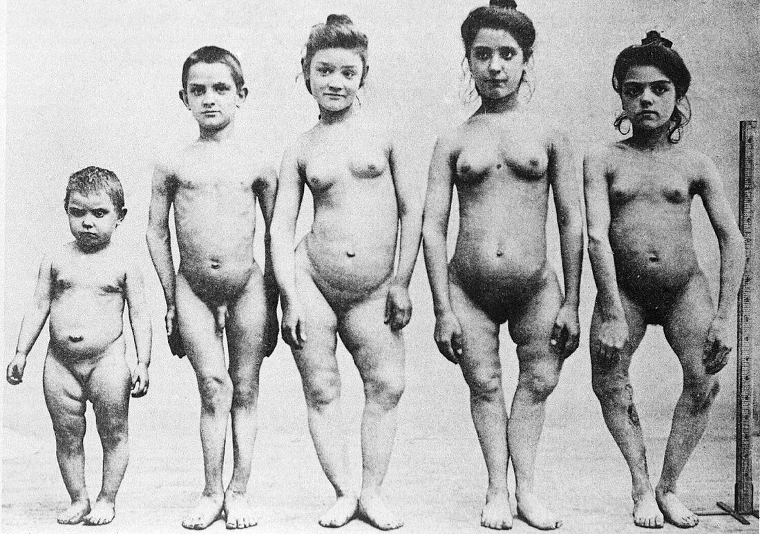 Rickets patients,circa 1900