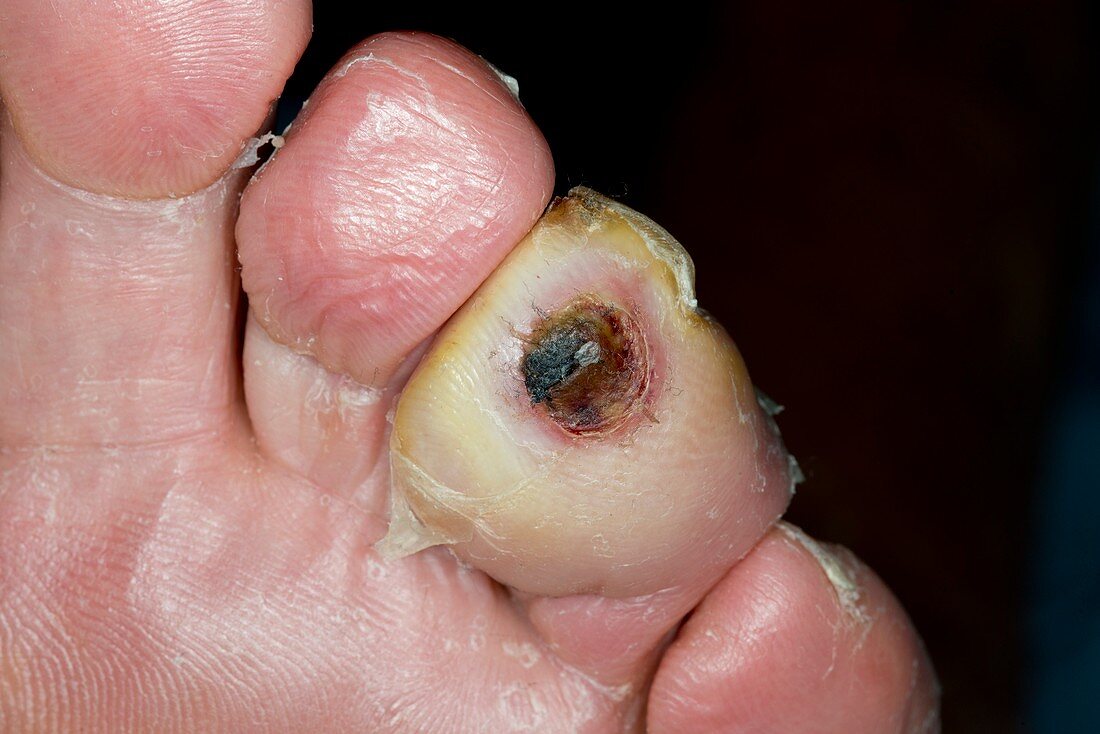 Infected toe in diabetes