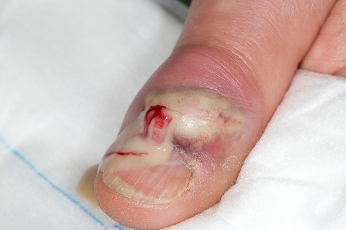 Thumb abscess