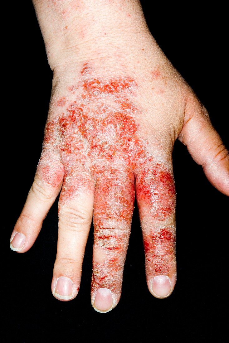 Infected eczema of the hand