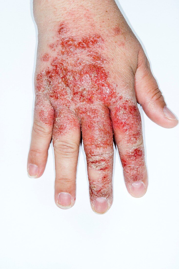 Infected eczema of the hand