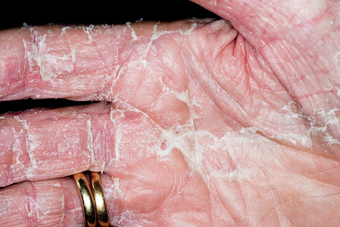 Exfoliative dermatitis of the hand