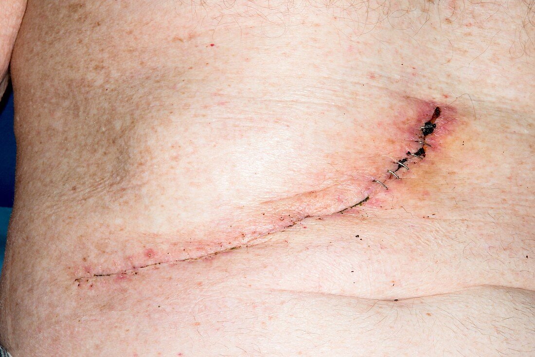 Surgical wound