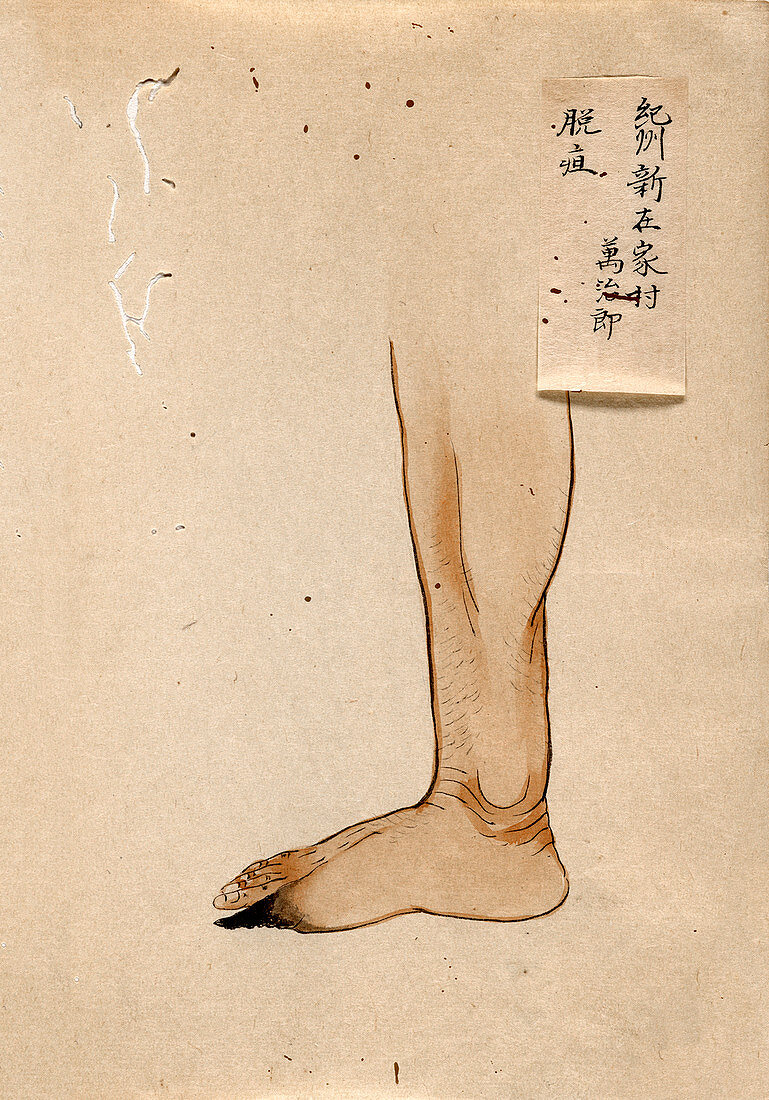 Gangrenous toe,19th-century Japan
