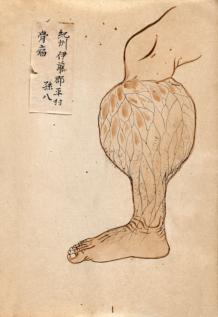 Swollen lower leg,19th-century Japan