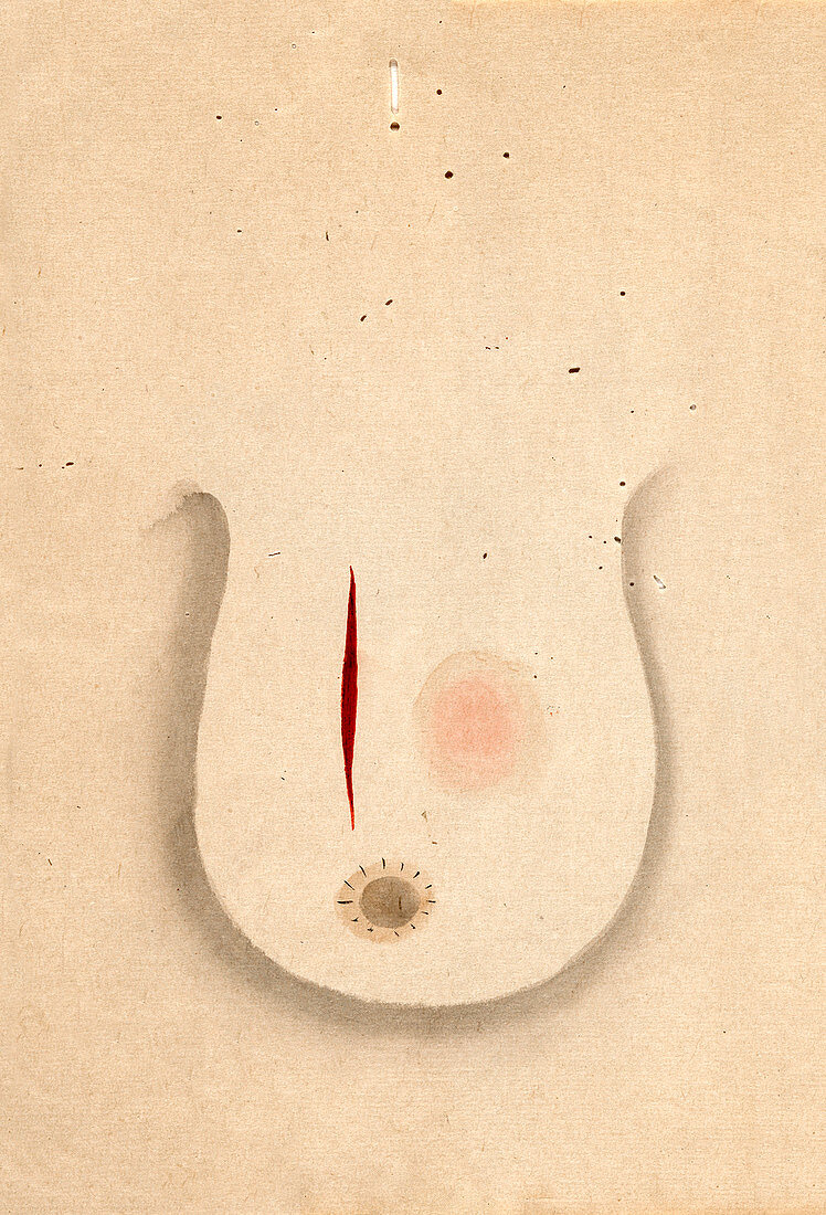 Breast cancer surgery,19th-century Japan