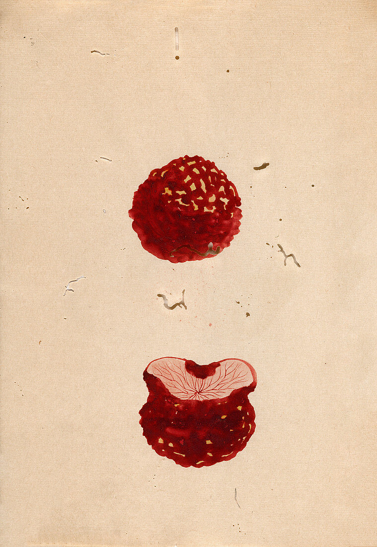 Excised breast cancer,19th-century Japan