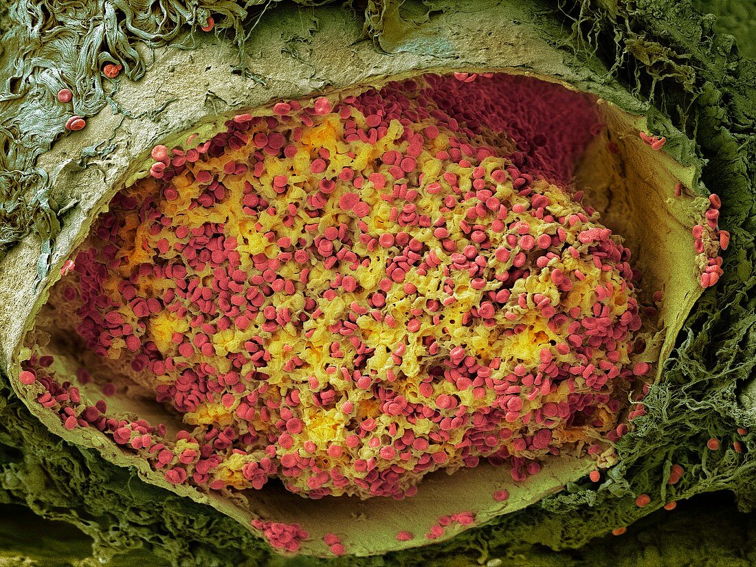 Blood clot in the lung,SEM