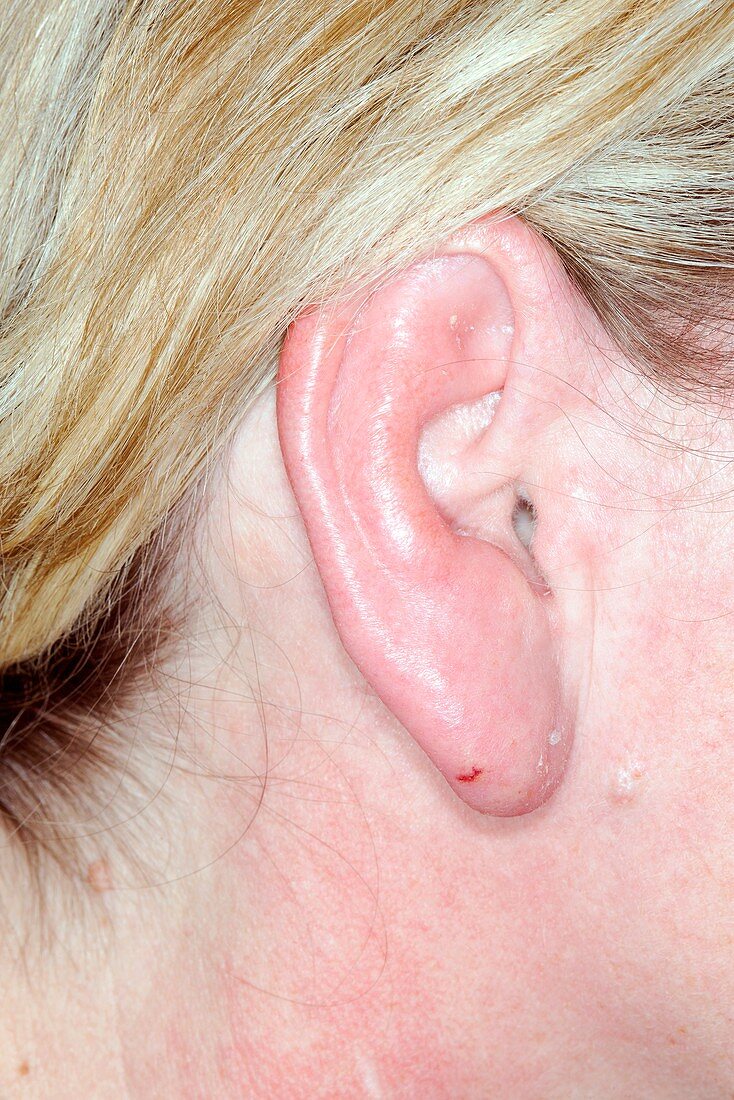 Cellulitis of the ear