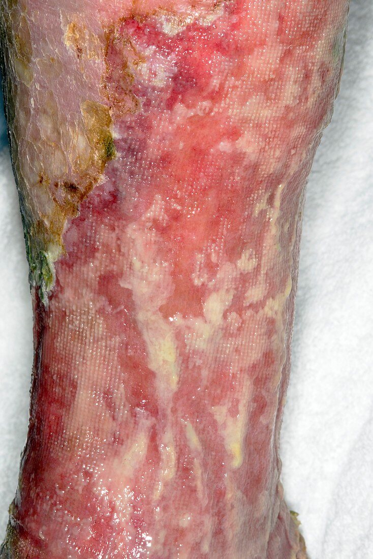 Ulcerated varicose veins