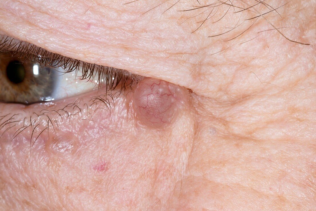 Eyelid cyst