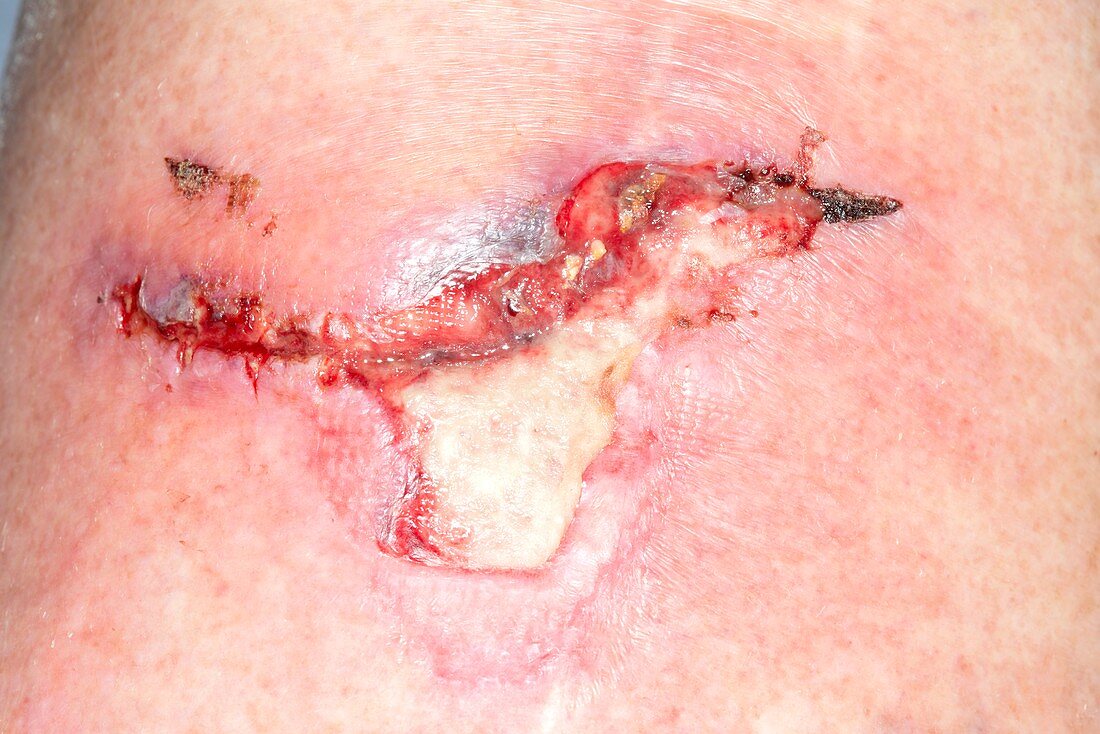 Infected knee laceration