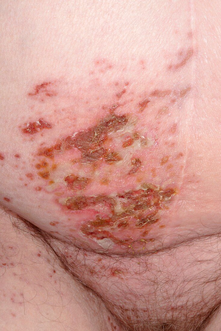 Shingles