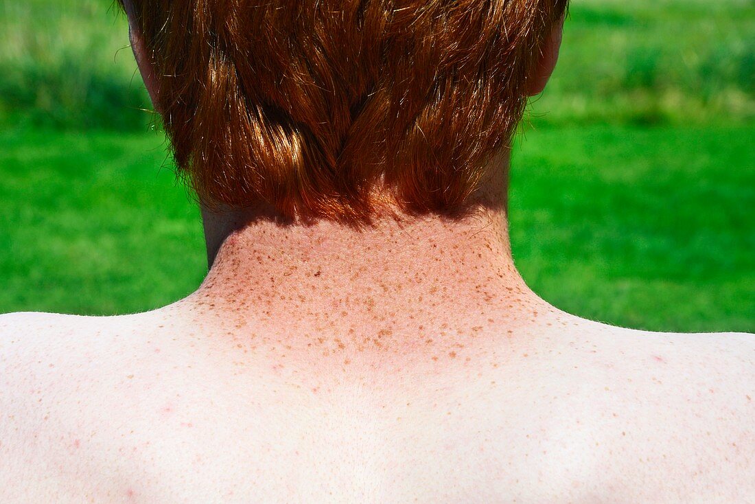 Sun-tanned freckled neck