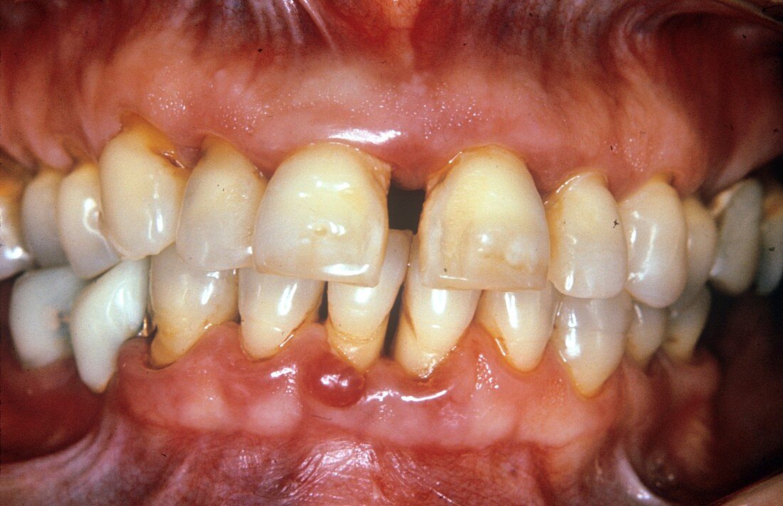Severe gum disease
