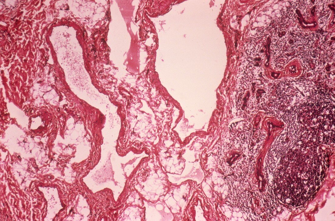 Salivary lymphangioma,light micrograph
