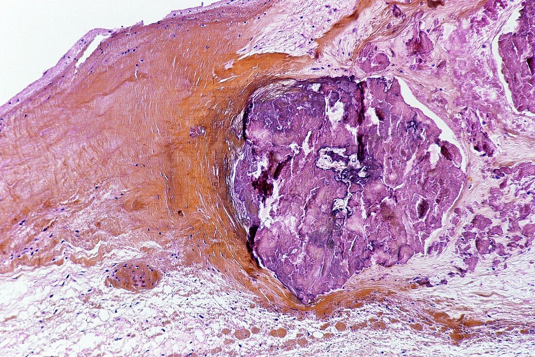 Infective endocarditis,light micrograph