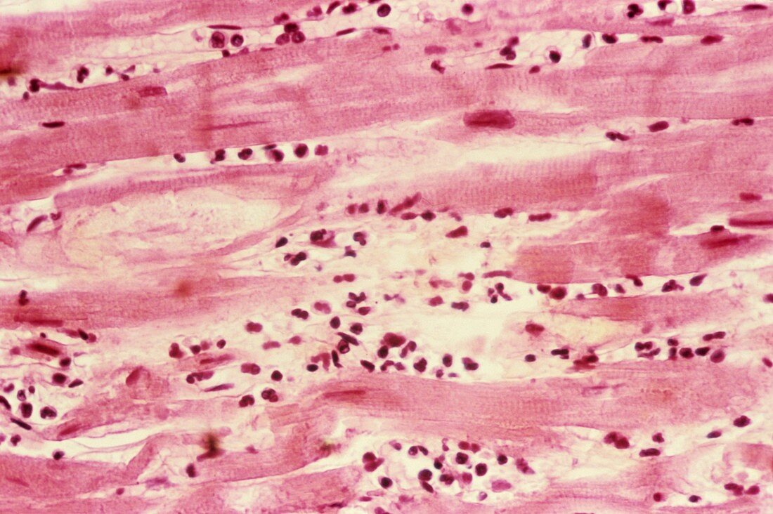 Heart myxoedema in hyperthyroidism