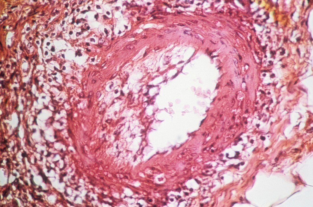 Polyarteritis nodosa,light micrograph