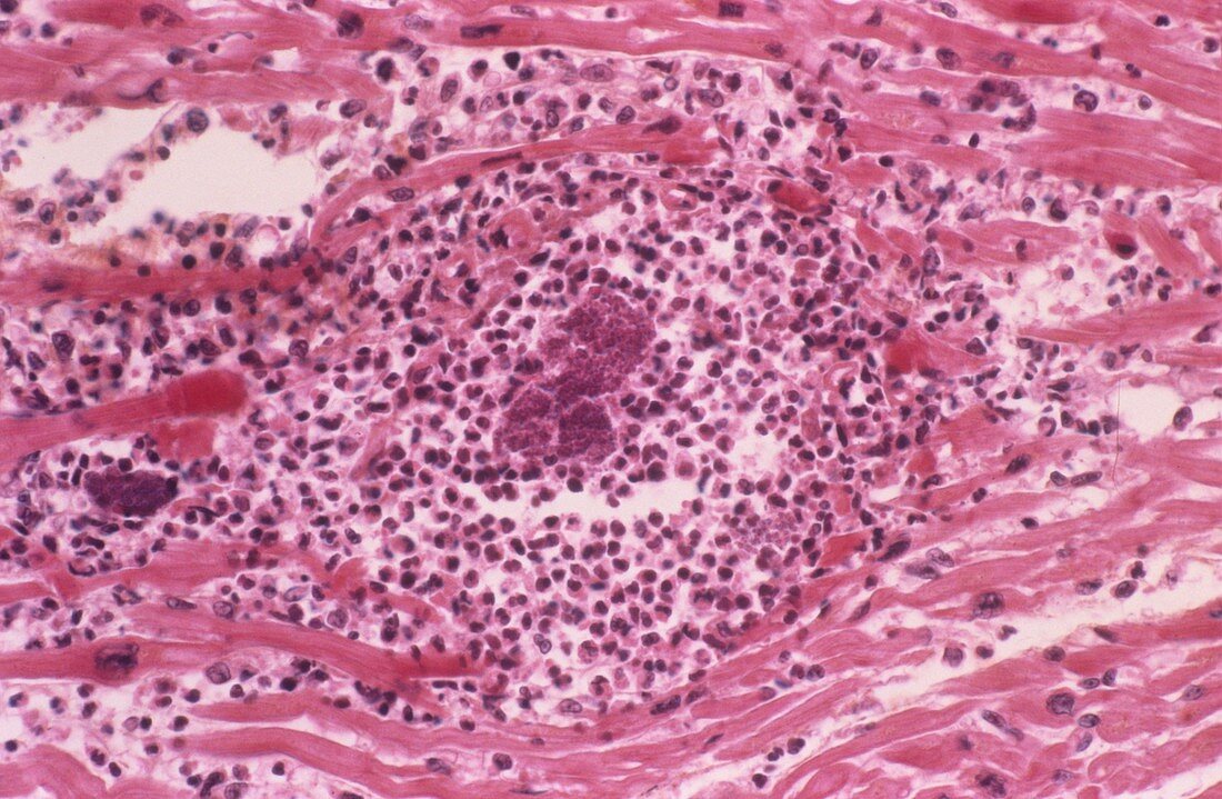 Abscess in myocarditis,light micrograph