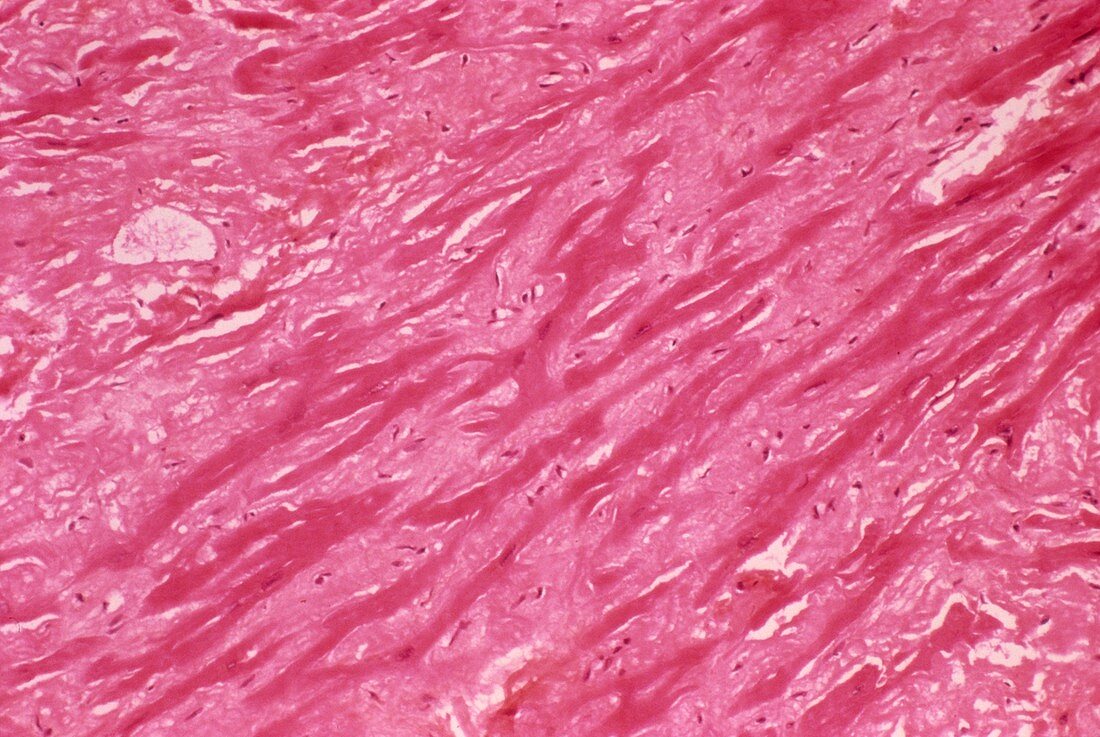 Cardiac amyloidosis,light micrograph