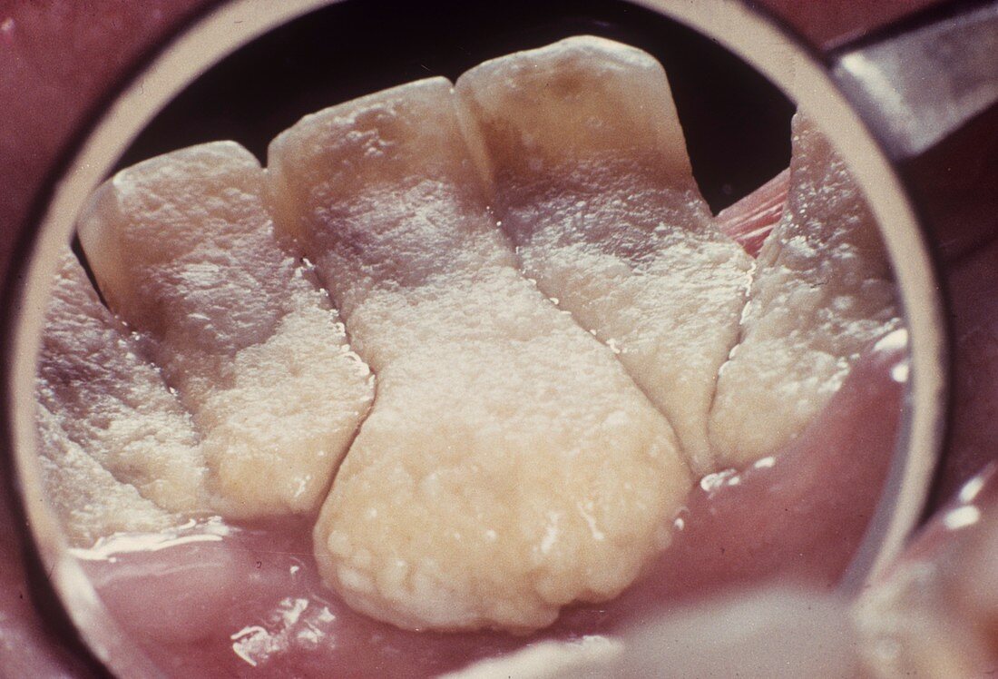 Dental tartar