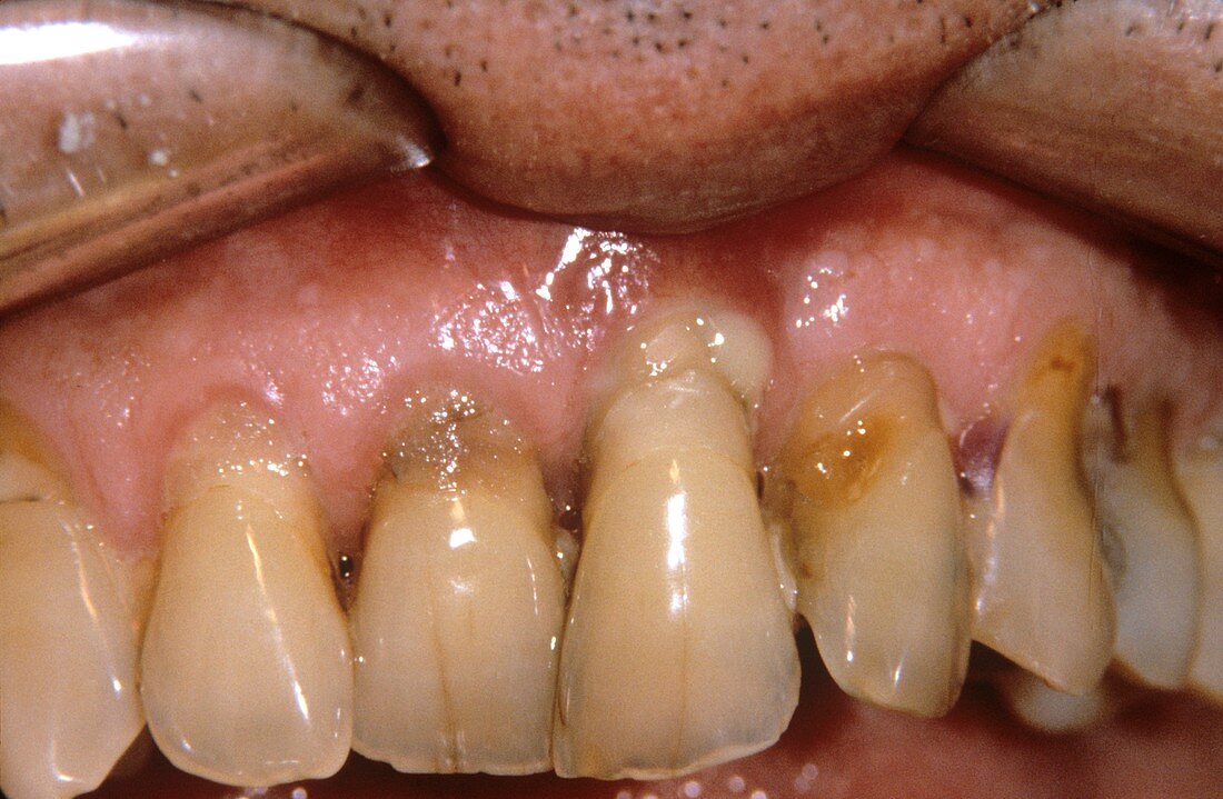 Abscess in severe gum disease