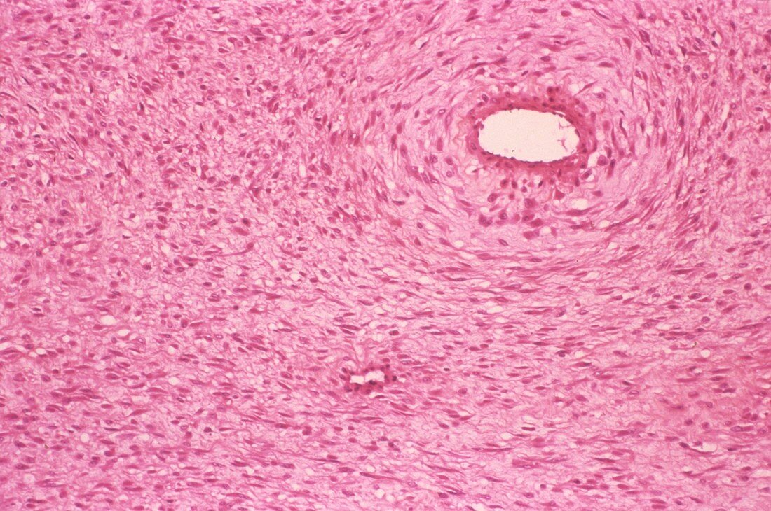 Desmoid fibroma,light micrograph