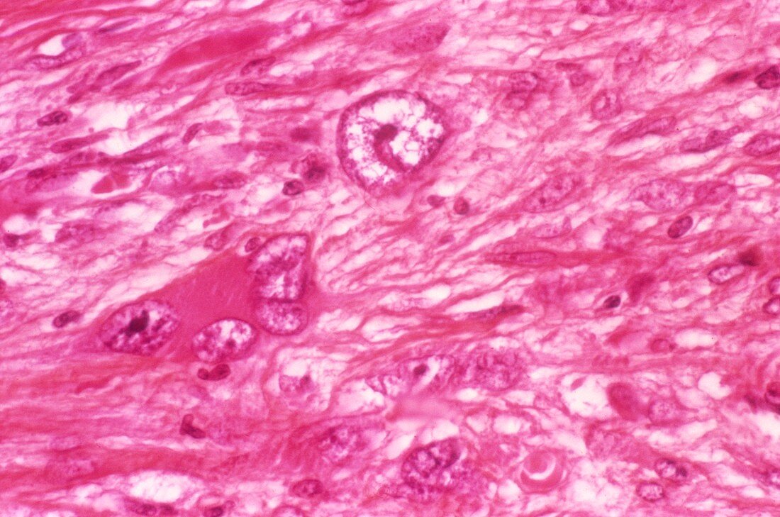 Rhabdomyosarcoma,light micrograph