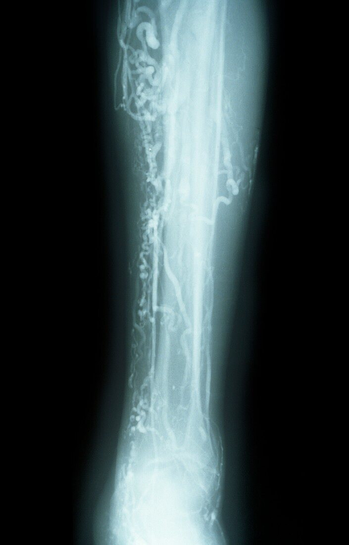 Varicose veins,X-ray