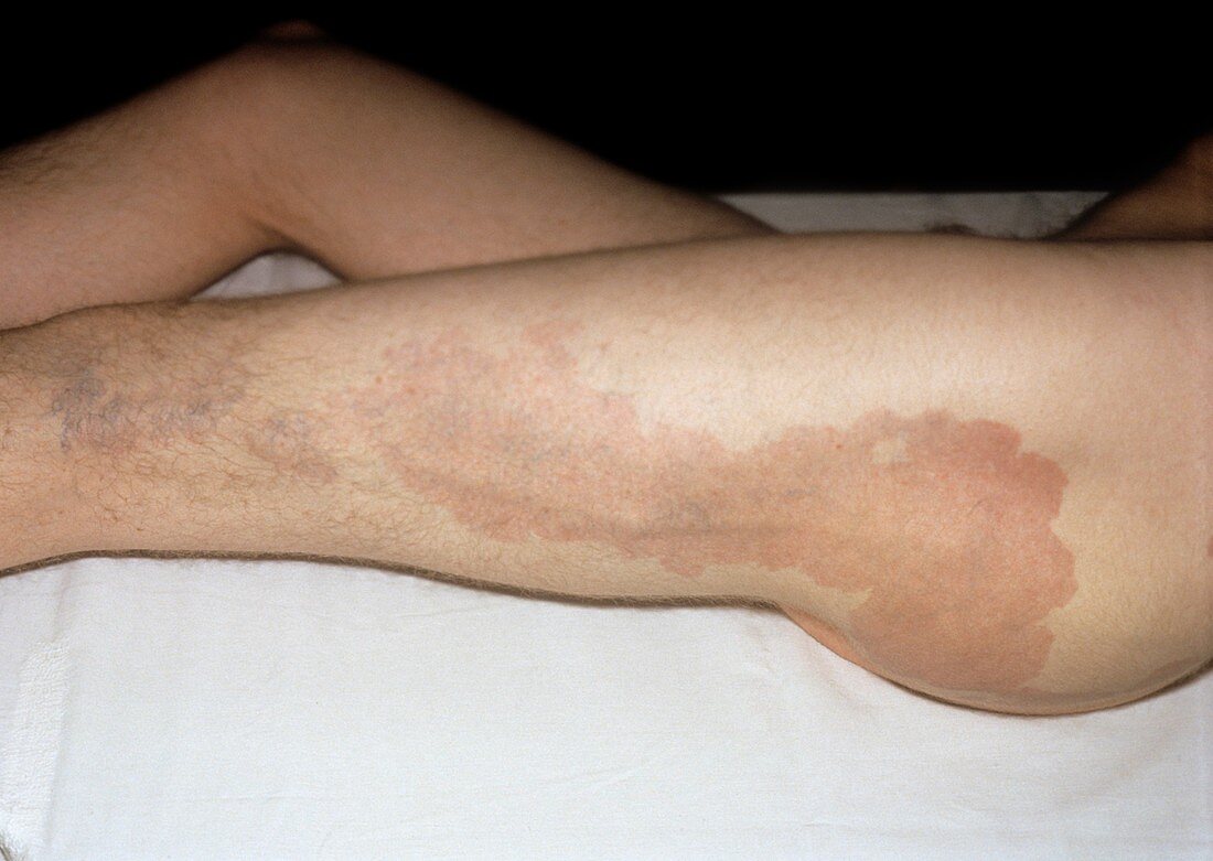 Capillary haemangioma and varicose veins