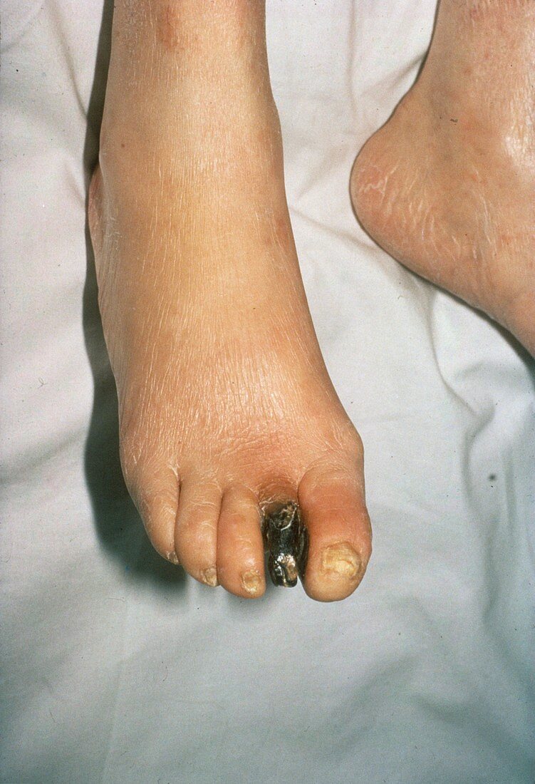 Gangrenous toe in diabetes