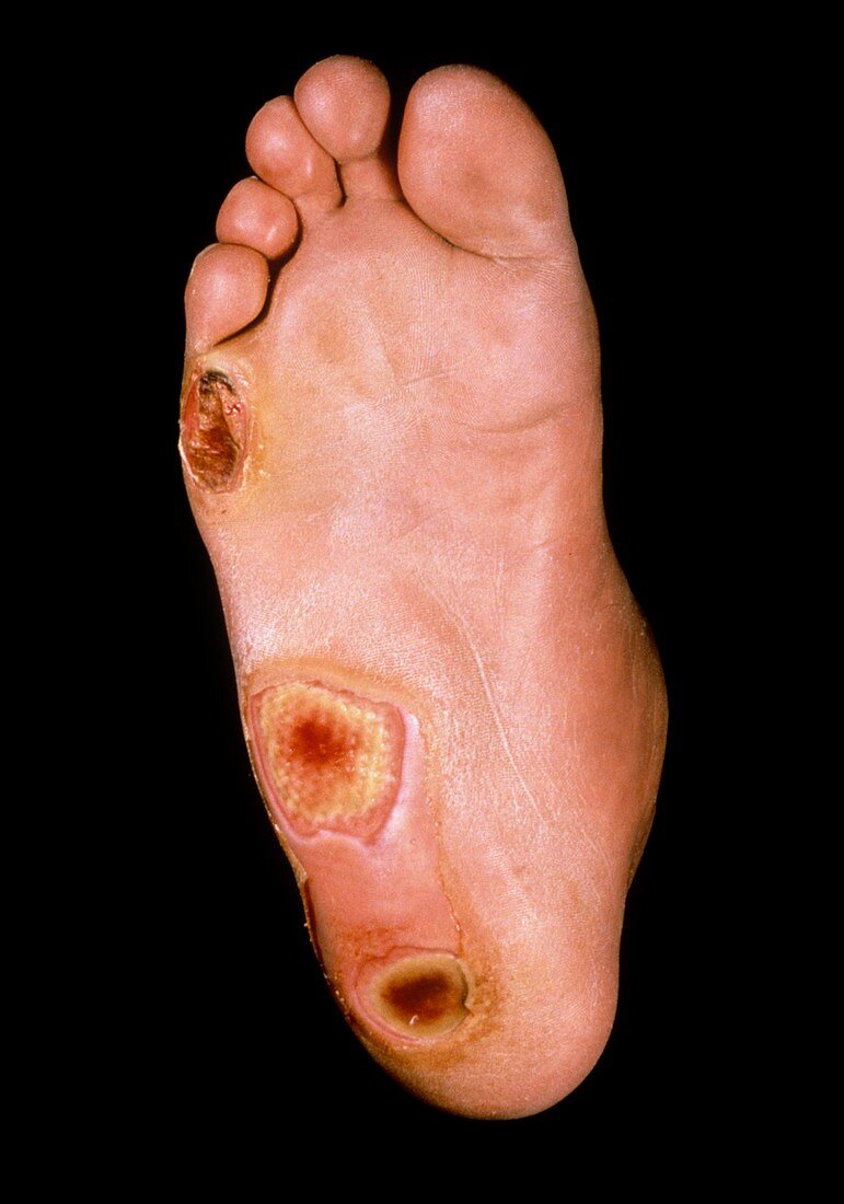 Foot ulcers in diabetes