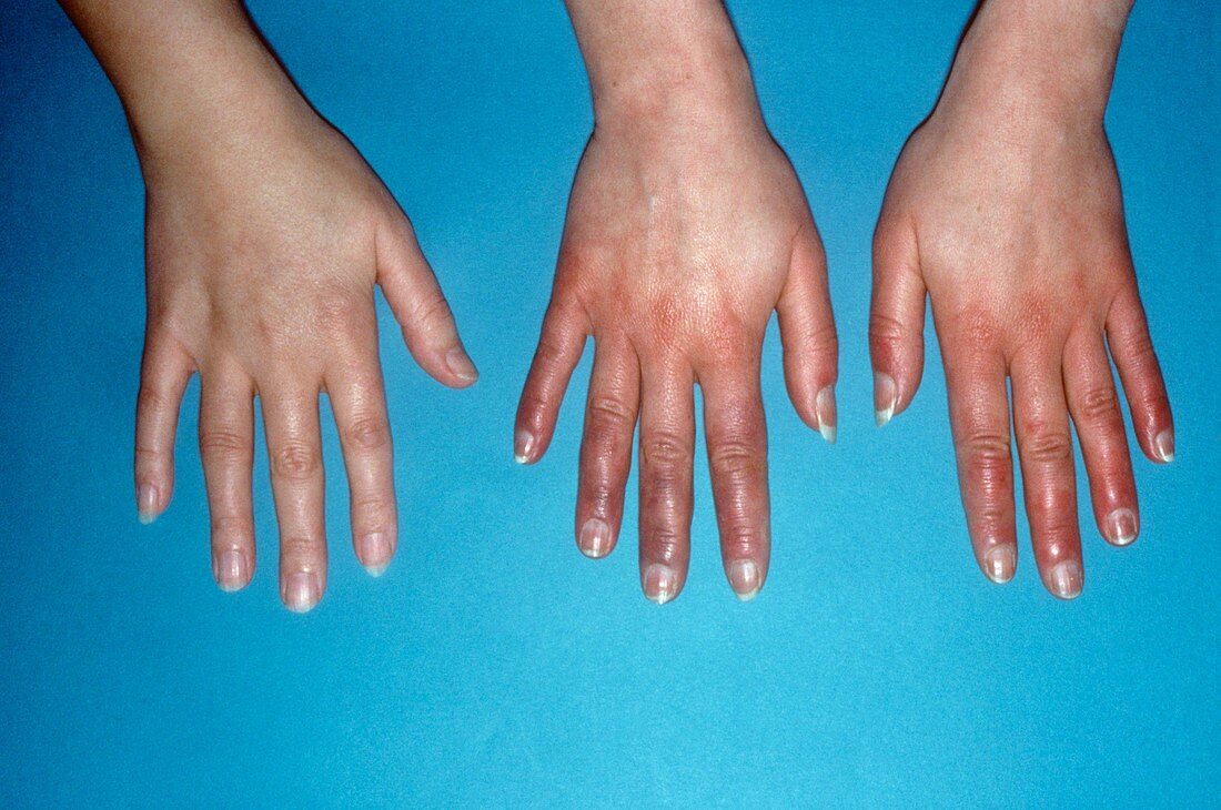 Acrocyanosis of the hands