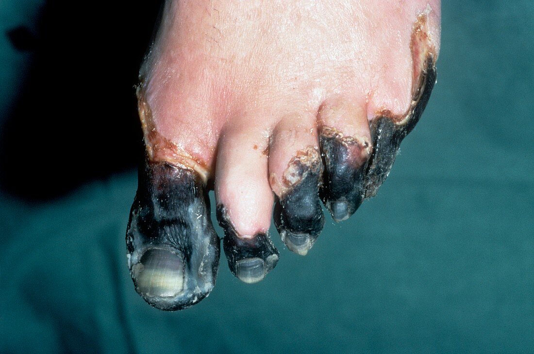 Gangrenous foot